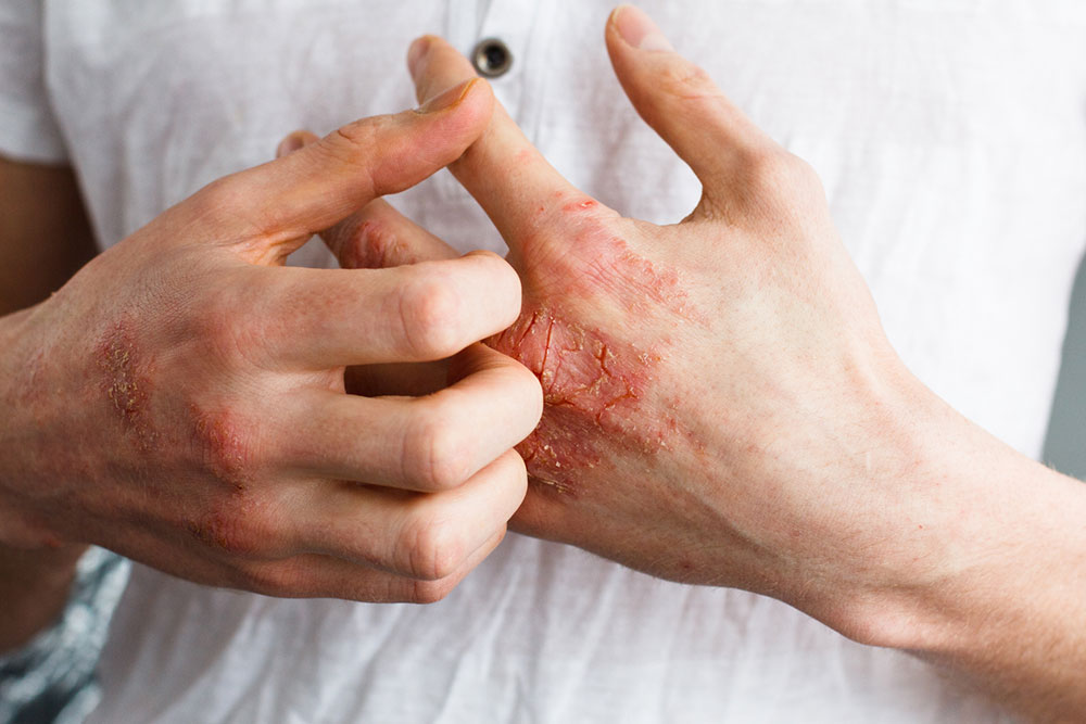 Eczema – foods to eat and avoid
