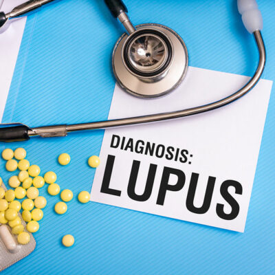 Everything you need to know about lupus