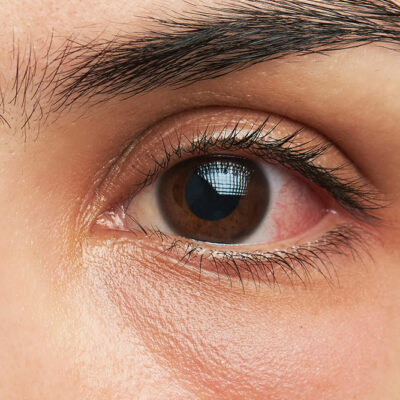 Symptoms of eye infections