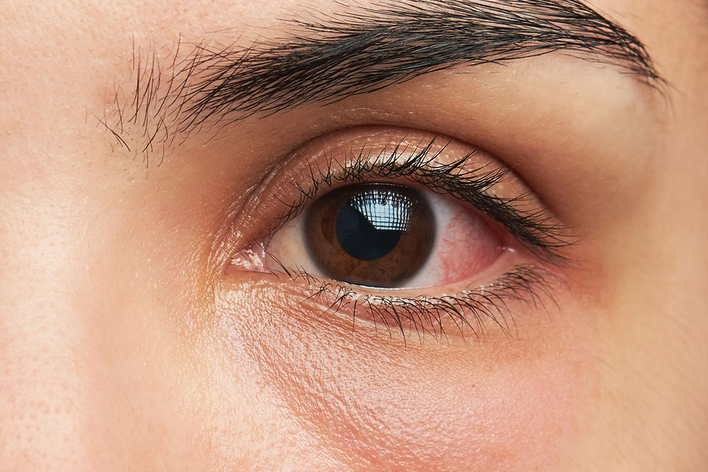 Symptoms of eye infections