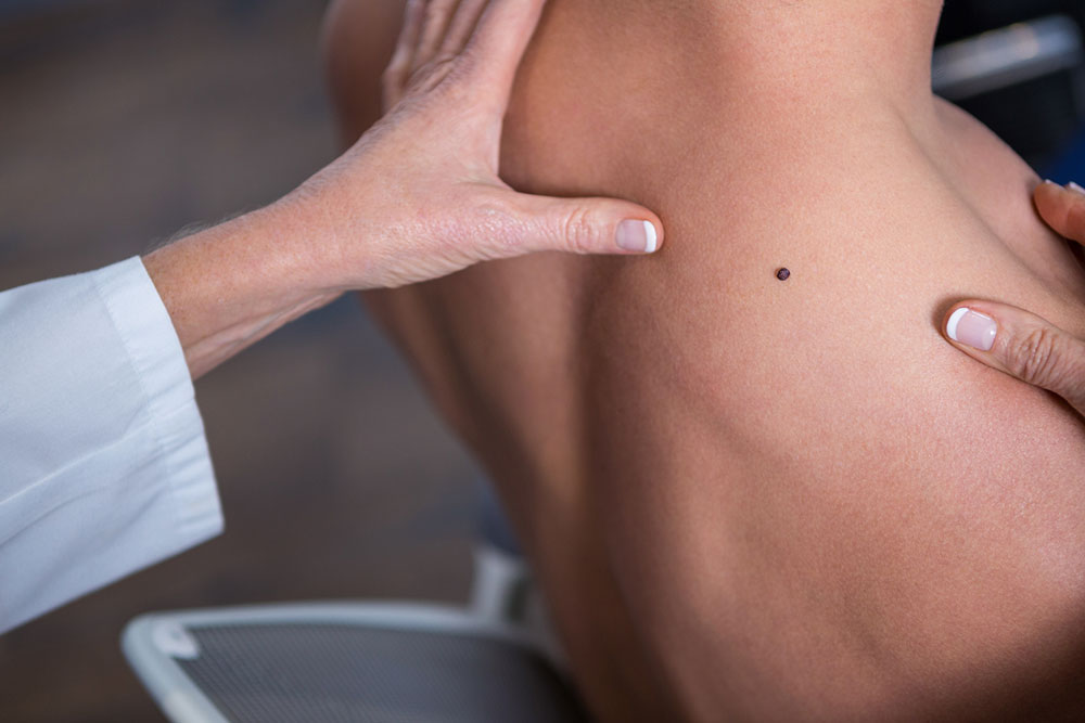 Things you need to know about Melanoma